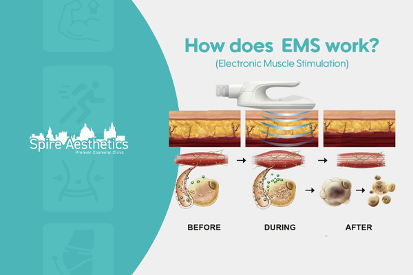 EMS treatment for post pregnancy weight loss treatment Kirkby in Ashfield