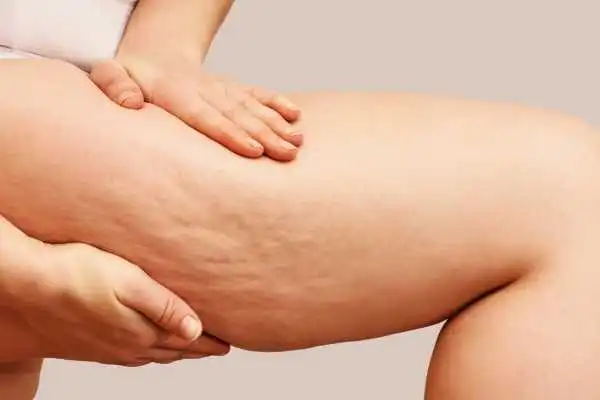 Image of woman showing leg with cellulite Kirkby in Ashfield
