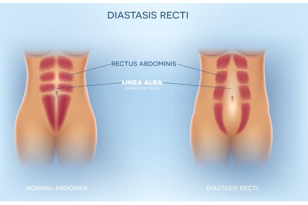 What Non-Surgical Options Are Available for Diastasis Recti Kirkby in Ashfield?