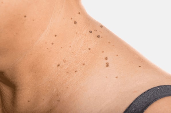 Are you looking for easy skin tag removal Kirkby in Ashfield - then contact Spire today!