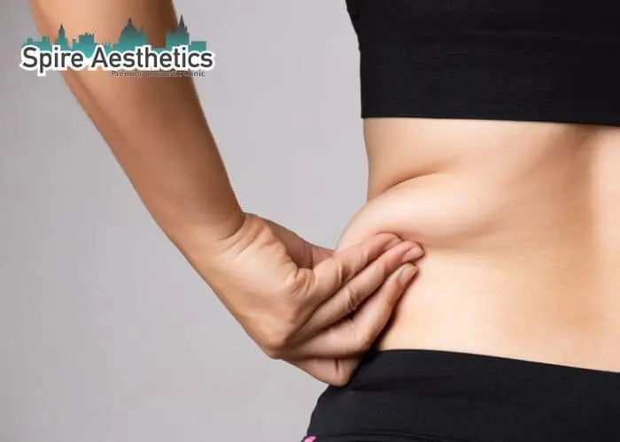 Image of woman pinching fat on their hips Kirkby in Ashfield. Fat Freezing treatment