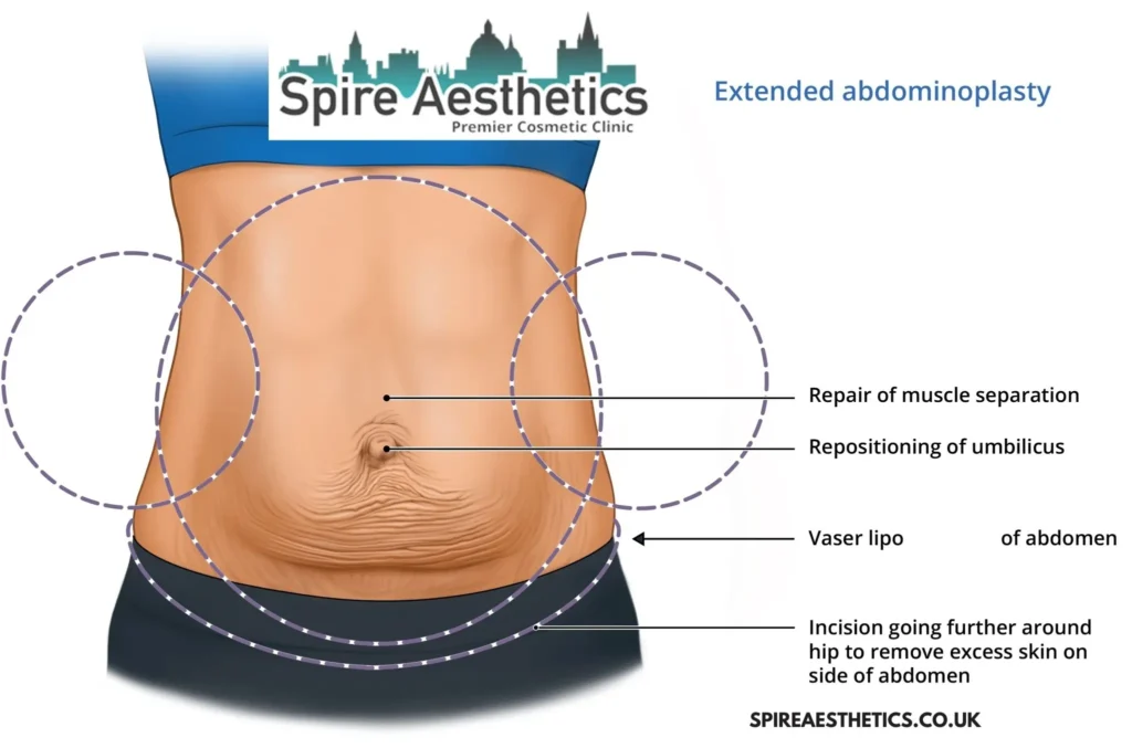 Understanding Loose Skin After Gastric Band Kirkby in Ashfield Surgery and HIFU Treatment