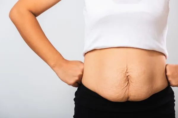 Image of a woman's stomach after weight loss with sagging skin following a gastric band Kirkby in Ashfield