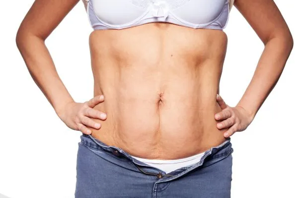 sagging skin on woman's stomach after weight loss injections Kirkby in Ashfield