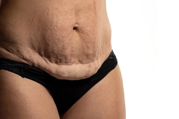 Image of womans stomach after weight loss injections Kirkby in Ashfield showing saggy skin