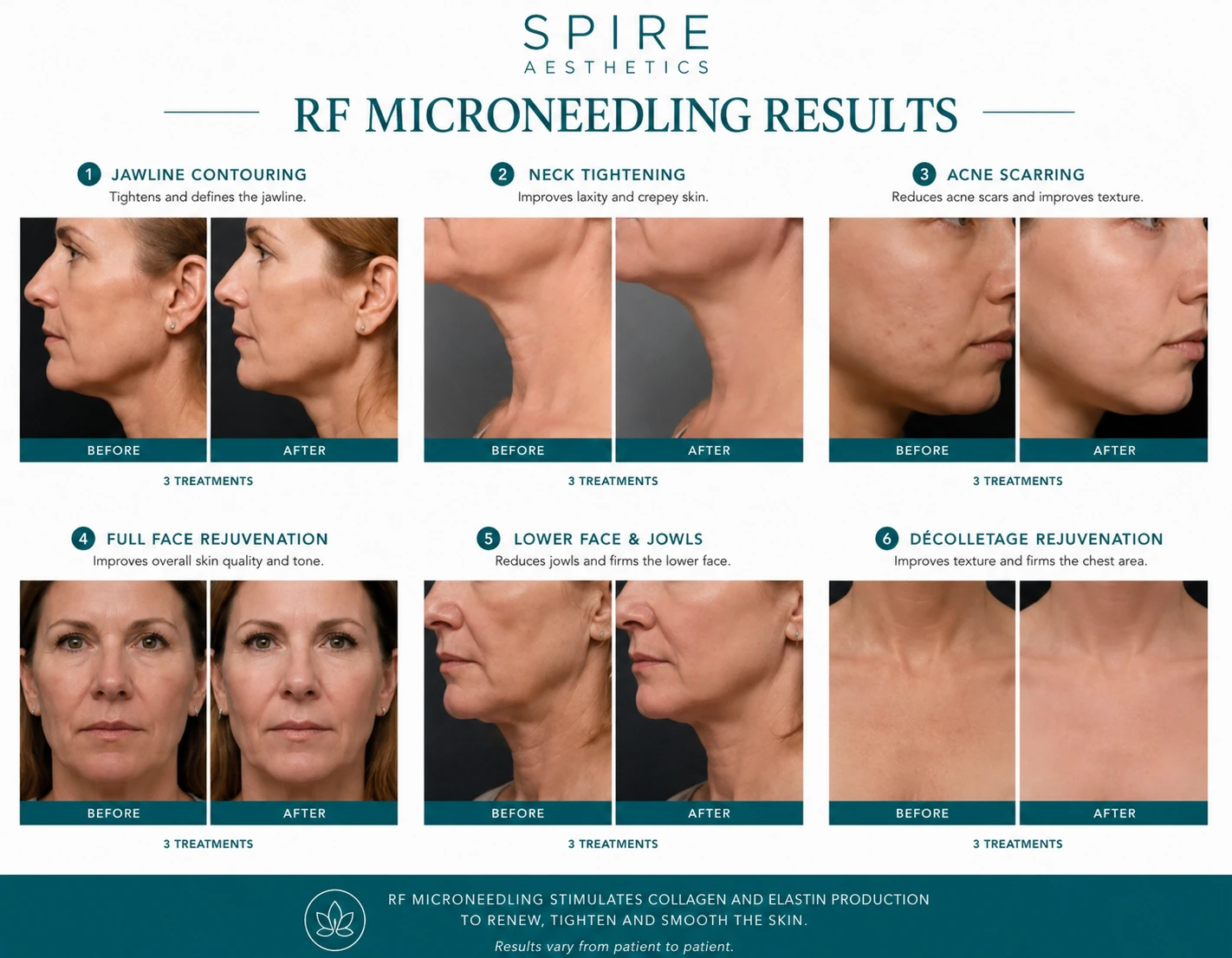 RF Microneedling Skin tightening Kirkby in Ashfield results