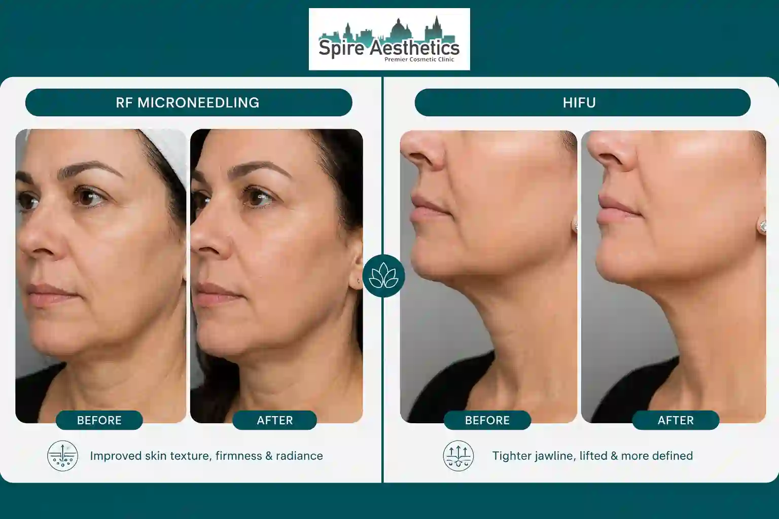 Can RF Microneedling and HIFU Be Combined Kirkby in Ashfield?