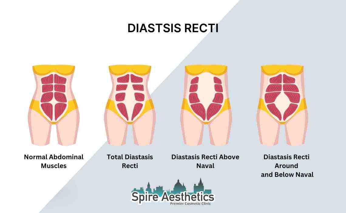 Is Non-Surgical Diastasis Recti Treatment Right for You? Common Concerns Answered Kirkby in Ashfield